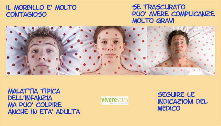 Il morbillo: malattia infettiva virale Il morbillo: malattia infettiva virale